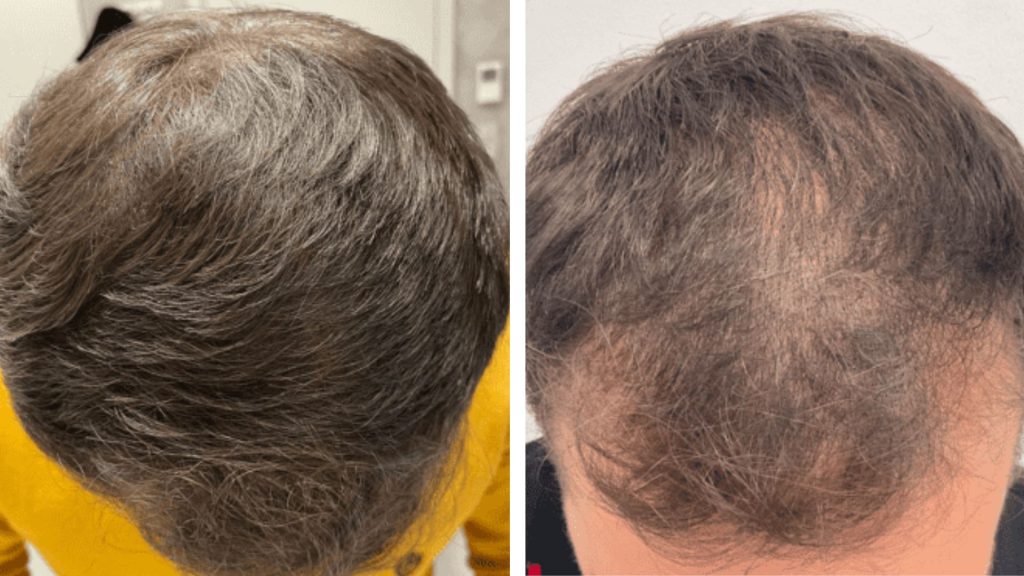 הוכחת תוצאות: השוואת לפני ואחרי של קרקפת גבר (המטופל שראינו באבחון), המציגה מעבר משיער דליל ומוחלש בתחילת הסדרה, לשיער עבה, חזק ובריא יותר לאחר פרוטוקול 'שגב' לחיזוק שיער טבעי ללא ניתוח.